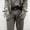 photograph of coal miner's hands with finger missing